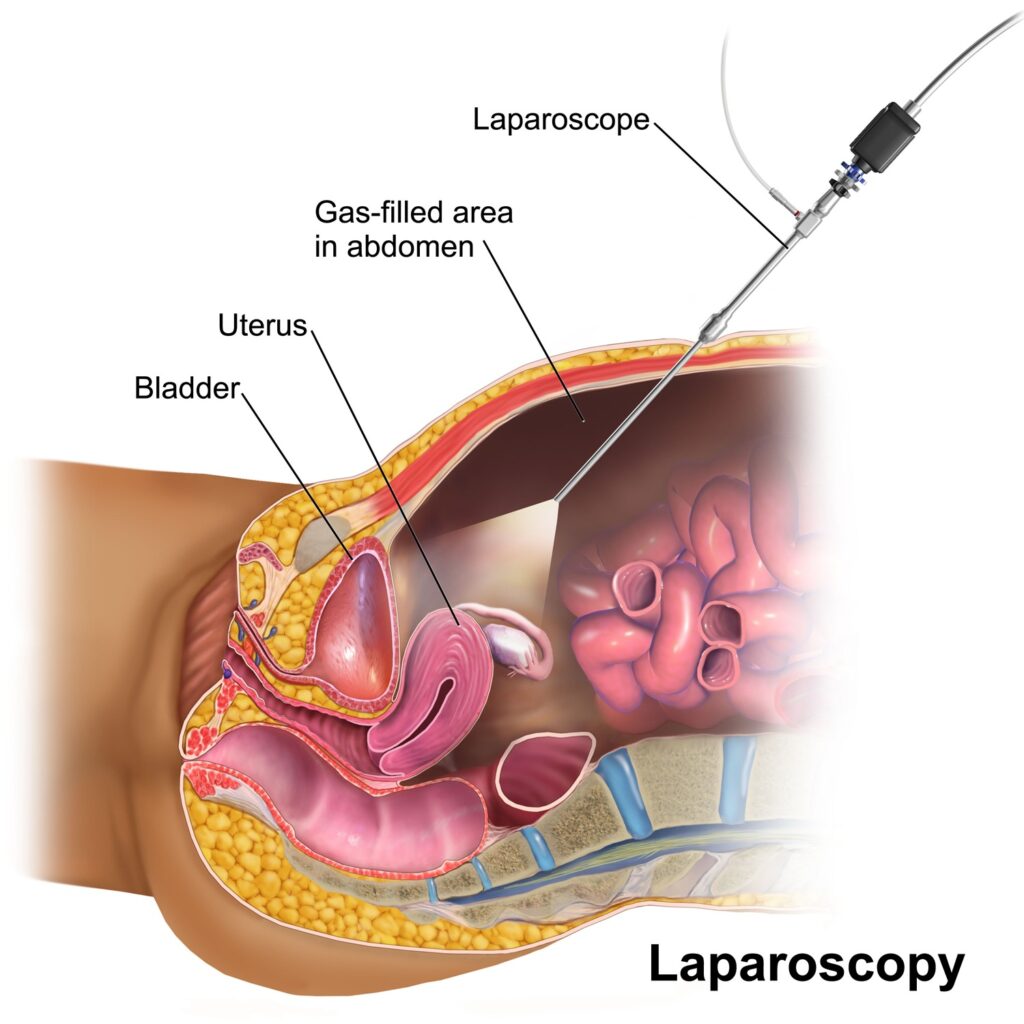 Best Laparoscopy Treatment in Panipat